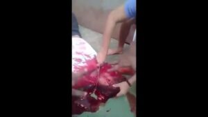 A group participant had his throat slice and also his tummy opened
