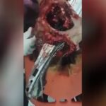 A piece of iron punctured via the skull