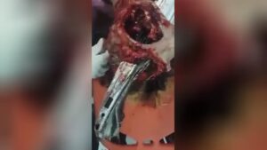 A piece of iron punctured via the skull