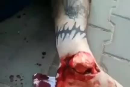 Man possesses an open leg crack – the foot is hung on the skin