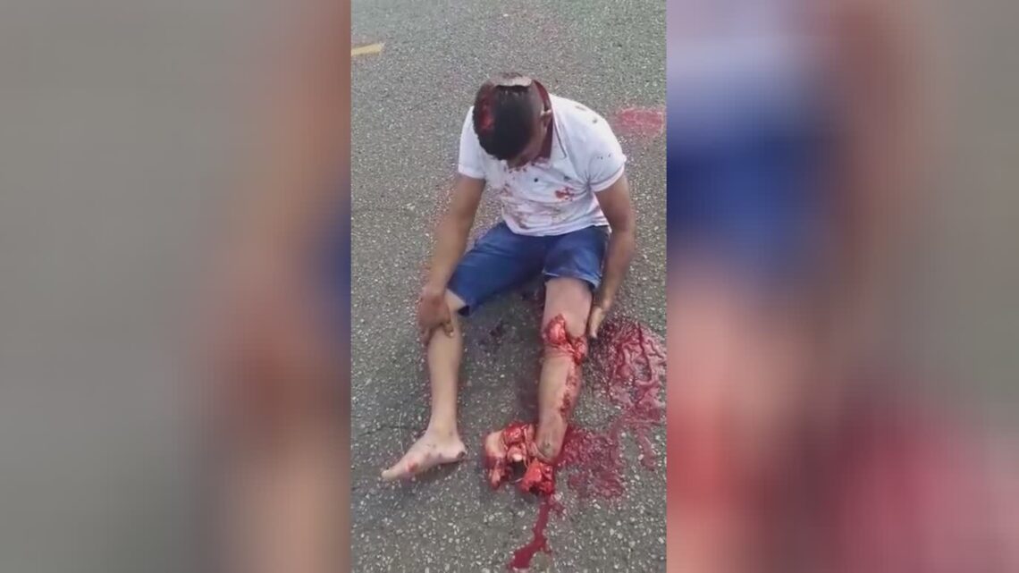 Right now you have lost your leg, give me an interview how it was