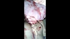 The lifeless guy's liver and eyes were actually removed