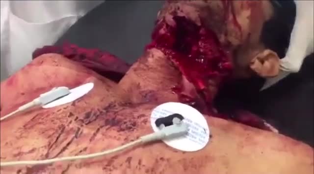 The scalp is actually practically removed