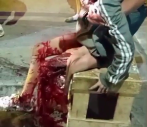 As A Result Of The Traffic Accident, The Young Woman Probably Lost Her Leg