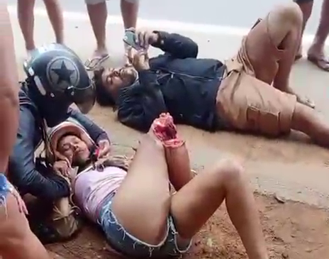 As A Result Of The Accident, The Woman Lost Her Leg Up To The Knee