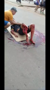 Unfortunately, A Young Man Lost His Leg As A Result Of A Traffic Accident 1 Unfortunately, A Young Man Lost His Leg As A Result Of A Traffic Accident