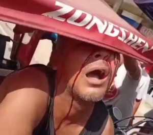 Dude Got Something Stuck In His Eye 3 Dude Got Something Stuck In His Eye