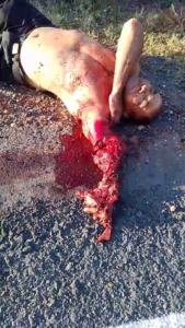 Doctors Saved The Man's Life, But They Couldn't Save His Arm