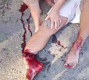 Doctors Must Make Maximum Efforts To Restore The Man's Leg