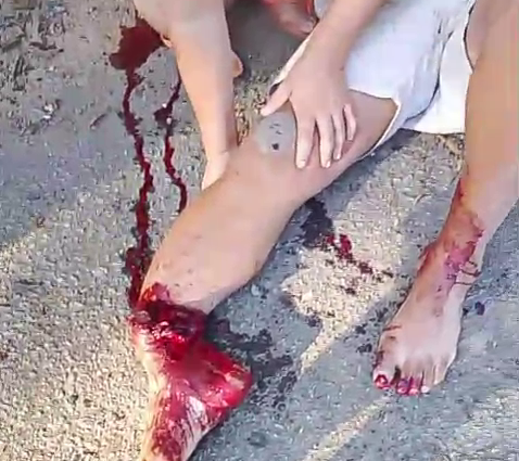Doctors Must Make Maximum Efforts To Restore The Man’s Leg