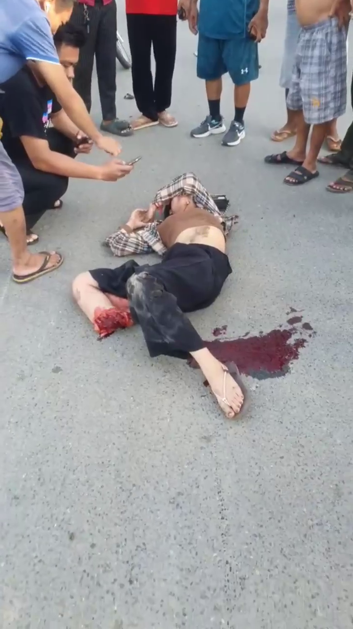 As A Result Of A Traffic Accident, A Young Woman Lost Her Leg