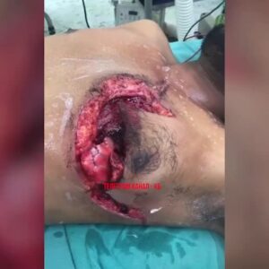 Extreme injuries to the chest