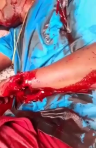 Dude Is Chopped Up With A Machete